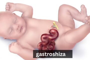 gastroshiza